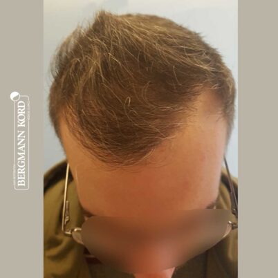 hair-transplantation-bergmann-kord-results-FUE-49048TL-6-months-later-top-001