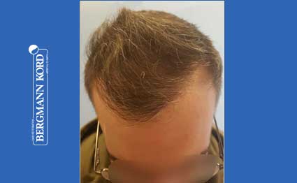 hair-transplantation-bergmann-kord-results-FUE-49048TL-after-001