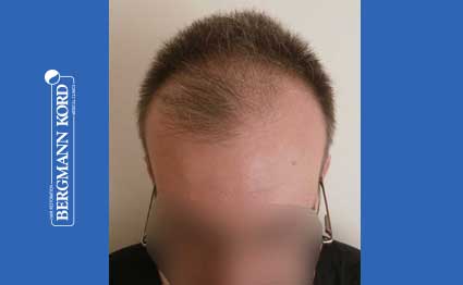 hair-transplantation-bergmann-kord-results-FUE-49048TL-before-001