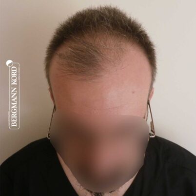 hair-transplantation-bergmann-kord-results-FUE-49048TL-before-front-001