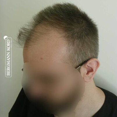 hair-transplantation-bergmann-kord-results-FUE-49048TL-before-left-001