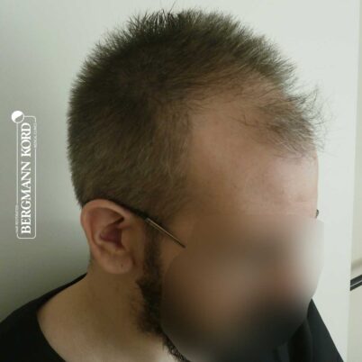 hair-transplantation-bergmann-kord-results-FUE-49048TL-before-right-001