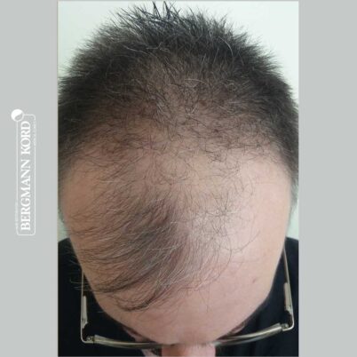 hair-transplantation-bergmann-kord-results-FUE-49048TL-before-top-001