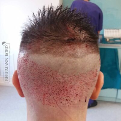 hair-transplantation-bergmann-kord-results-FUE-49048TL-donor-back-001