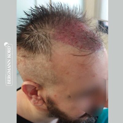 hair-transplantation-bergmann-kord-results-FUE-49048TL-during-the-operation-right-001