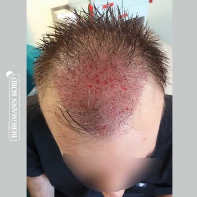 hair-transplantation-bergmann-kord-results-FUE-49048TL-during-the-operation-top-001