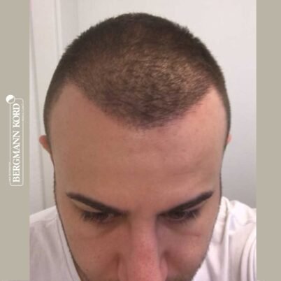 hair-transplantation-bergmann-kord-results-FUE-53046TL-3-months-front-001