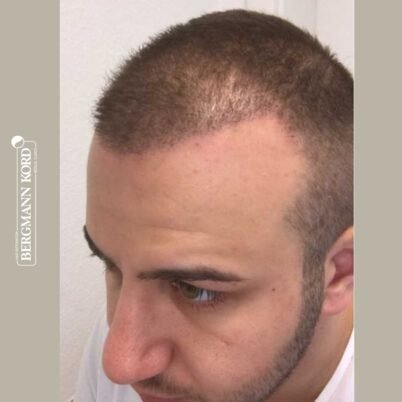 hair-transplantation-bergmann-kord-results-FUE-53046TL-3-months-left-001