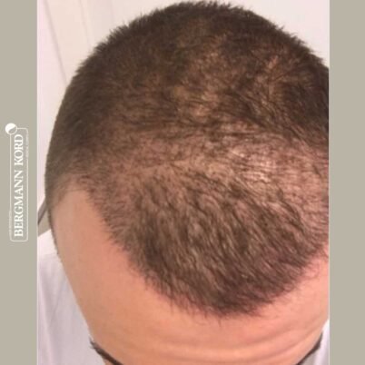 hair-transplantation-bergmann-kord-results-FUE-53046TL-3-months-top-001