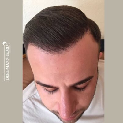 hair-transplantation-bergmann-kord-results-FUE-53046TL-6-months-front-001