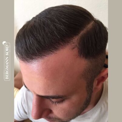 hair-transplantation-bergmann-kord-results-FUE-53046TL-6-months-left-001