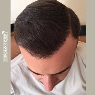 hair-transplantation-bergmann-kord-results-FUE-53046TL-6-months-top-001