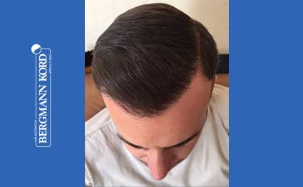 hair-transplantation-bergmann-kord-results-FUE-53046TL-after-001