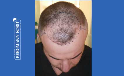 hair-transplantation-bergmann-kord-results-FUE-53046TL-before-001