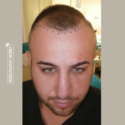 hair-transplantation-bergmann-kord-results-FUE-53046TL-before-front-001