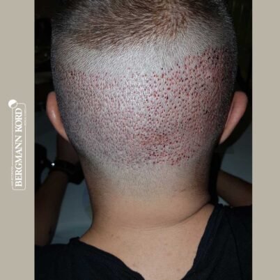 hair-transplantation-bergmann-kord-results-FUE-53046TL-donor-area-001