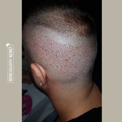 hair-transplantation-bergmann-kord-results-FUE-53046TL-donor-area-left-001