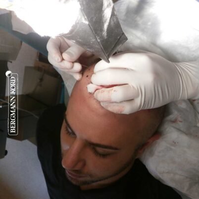 hair-transplantation-bergmann-kord-results-FUE-53046TL-during-the-operation-001