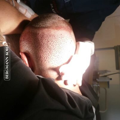 hair-transplantation-bergmann-kord-results-FUE-53046TL-during-the-operation-donor-area-001