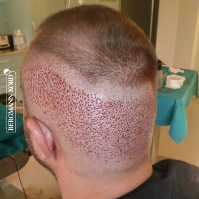 hair-transplantation-bergmann-kord-results-FUE-53046TL-during-the-operation-donor-area-left-001