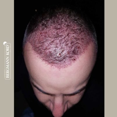 hair-transplantation-bergmann-kord-results-FUE-53046TL-this-day-front-001