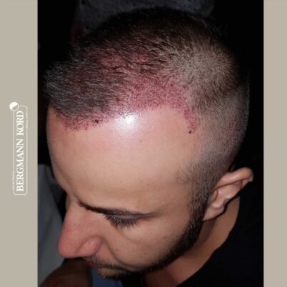 hair-transplantation-bergmann-kord-results-FUE-53046TL-this-day-left-001