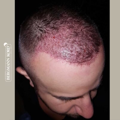 hair-transplantation-bergmann-kord-results-FUE-53046TL-this-day-right-001