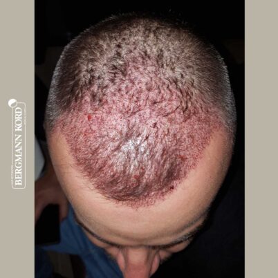 hair-transplantation-bergmann-kord-results-FUE-53046TL-this-day-top-001