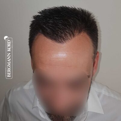 hair-transplantation-bergmann-kord-results-FUE-56047TL-10-months-later-front-001