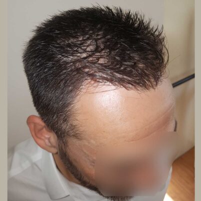 hair-transplantation-bergmann-kord-results-FUE-56047TL-10months-right-001