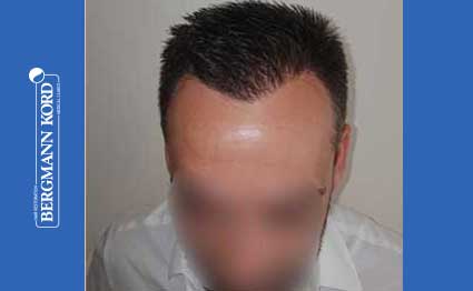 hair-transplantation-bergmann-kord-results-FUE-56047TL-after-001