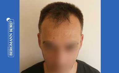 hair-transplantation-bergmann-kord-results-FUE-56047TL-before-001