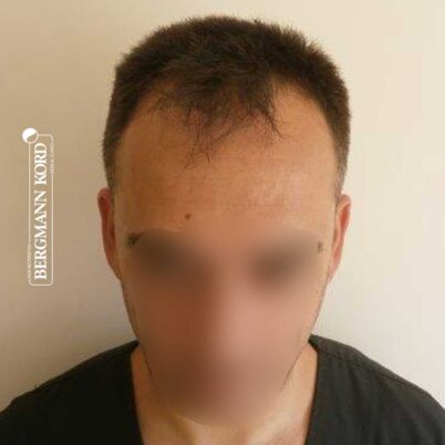 hair-transplantation-bergmann-kord-results-FUE-56047TL-before-front-001