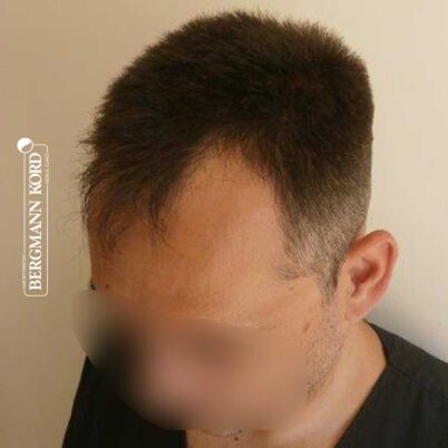 hair-transplantation-bergmann-kord-results-FUE-56047TL-before-left-001