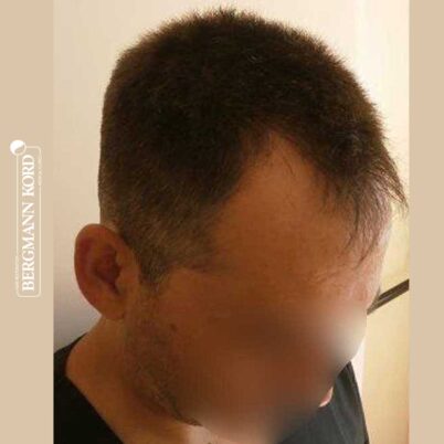 hair-transplantation-bergmann-kord-results-FUE-56047TL-before-right-001