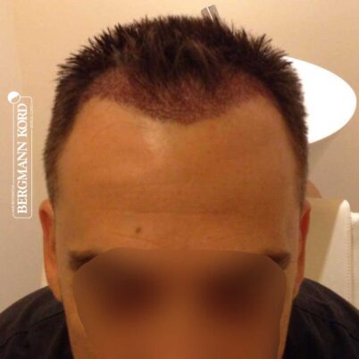 hair-transplantation-bergmann-kord-results-FUE-56047TL-this-day-front-001