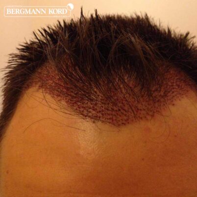 hair-transplantation-bergmann-kord-results-FUE-56047TL-this-day-front-002