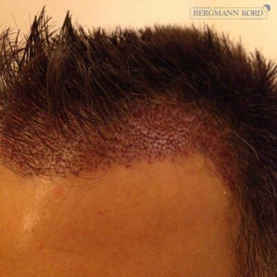 hair-transplantation-bergmann-kord-results-FUE-56047TL-this-day-left-001