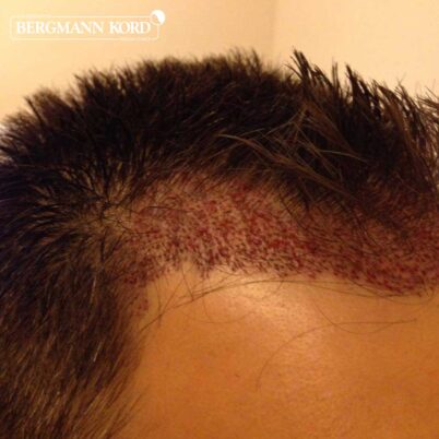 hair-transplantation-bergmann-kord-results-FUE-56047TL-this-day-right-001