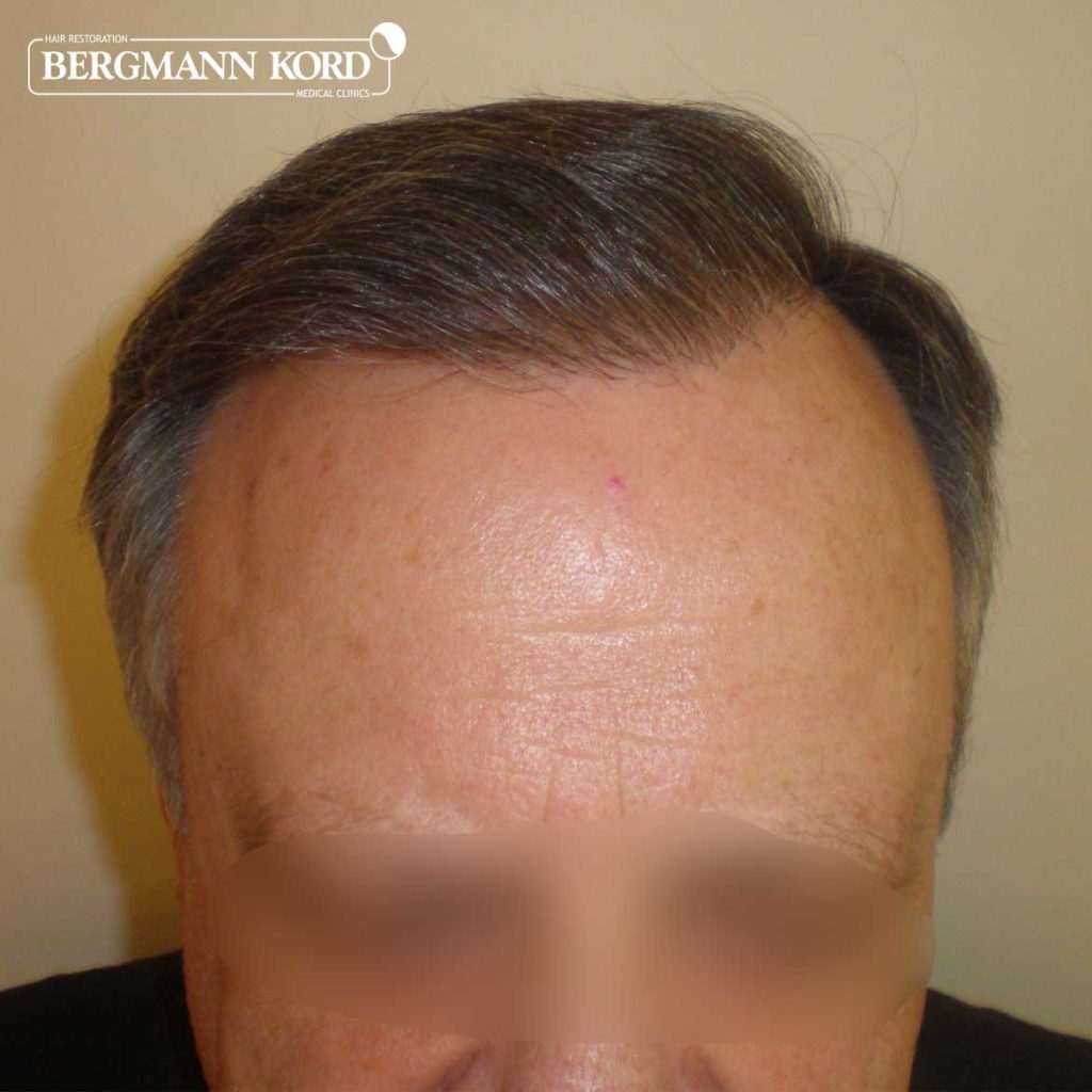 hair-transplantation-bergmann-kord-results-FUT-49021TL-after-front-001