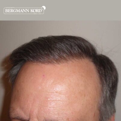 hair-transplantation-bergmann-kord-results-FUT-49021TL-after-front-right-001