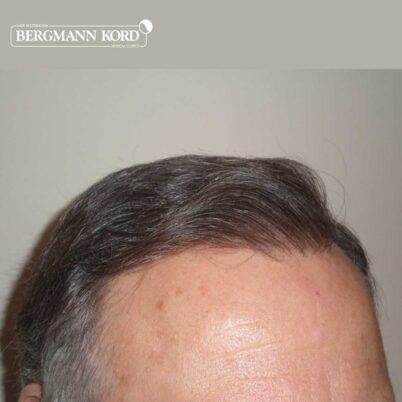 hair-transplantation-bergmann-kord-results-FUT-49021TL-after-left-001