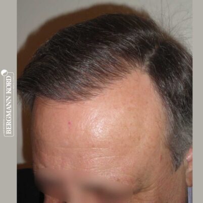 hair-transplantation-bergmann-kord-results-FUT-49021TL-after-right-001