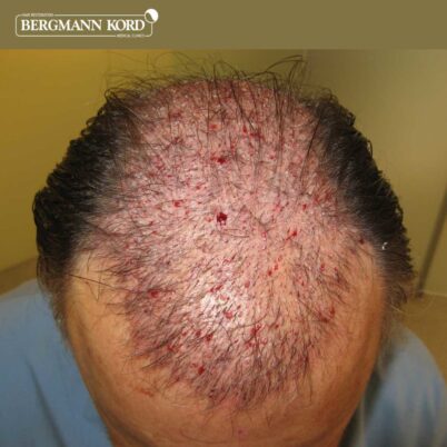 hair-transplantation-bergmann-kord-results-FUT-49021TL-after-the-surgery-front-001