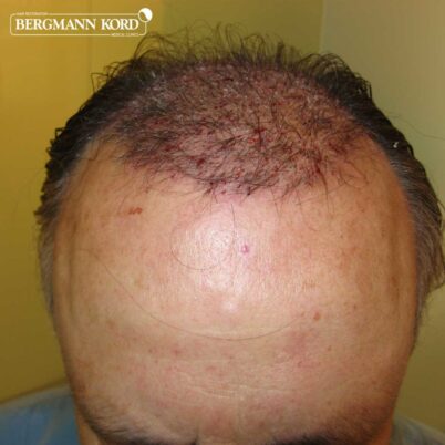 hair-transplantation-bergmann-kord-results-FUT-49021TL-after-the-surgery-top-001