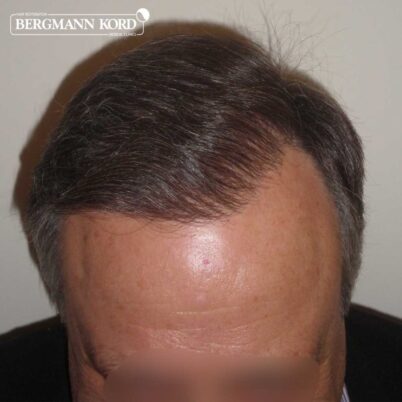 hair-transplantation-bergmann-kord-results-FUT-49021TL-after-top-001