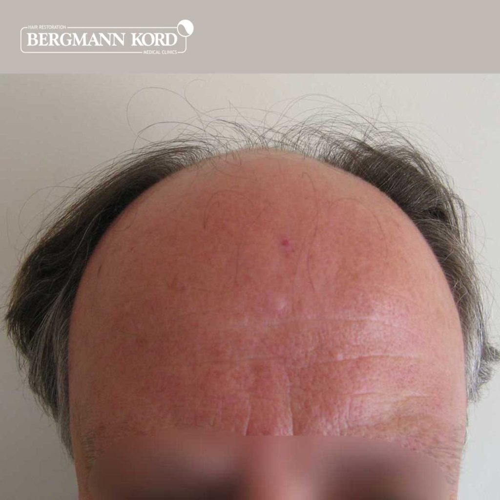 hair-transplantation-bergmann-kord-results-FUT-49021TL-before-front-001