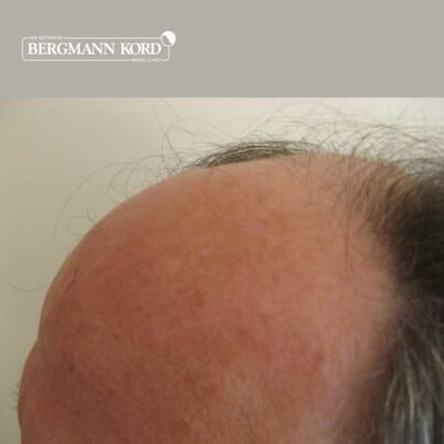 hair-transplantation-bergmann-kord-results-FUT-49021TL-before-left-001