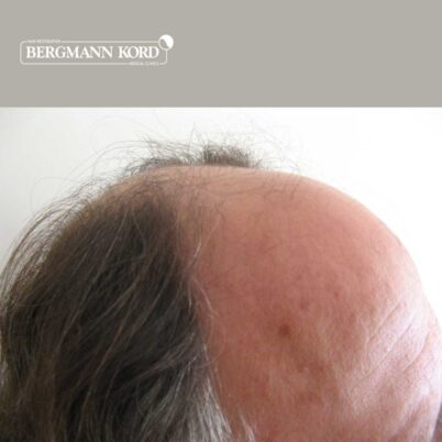 hair-transplantation-bergmann-kord-results-FUT-49021TL-before-right-001