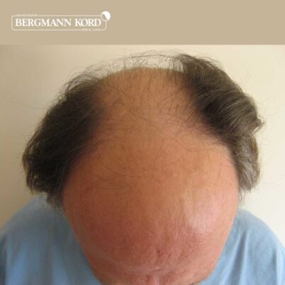 hair-transplantation-bergmann-kord-results-FUT-49021TL-before-top-001